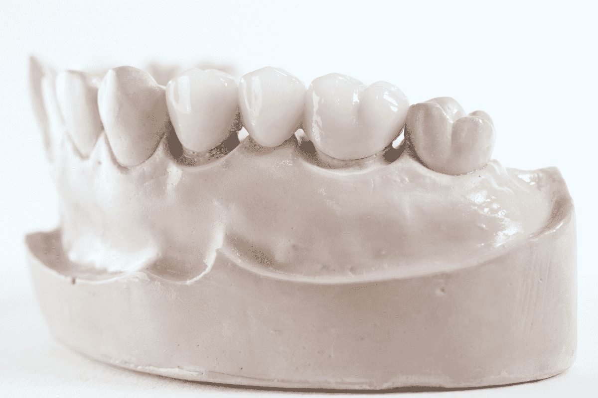 What is a Dental Bridge Procedure?