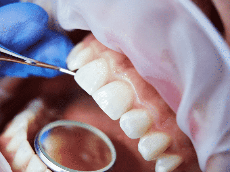 Langley Cosmetic Dentistry: The Benefits of Teeth Whitening