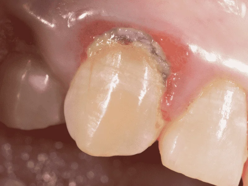 Understanding How Plaque and Tartar Damage Your Teeth